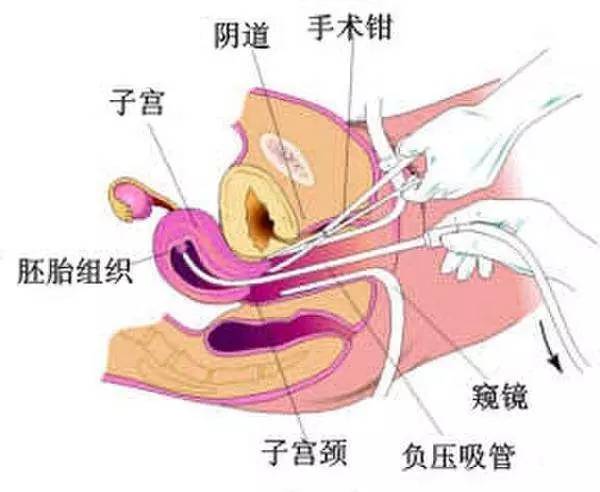 怀孕一个月怎么做人流,怀孕一个月如何进行人工流产，全面指南